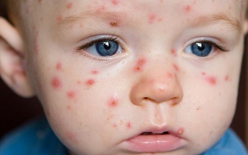 Fruit allergies and intolerances require cautious juice introduction to ensure the baby’s safety